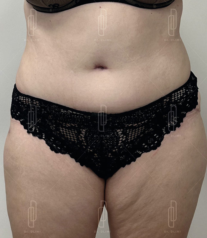 Après abdominoplastie