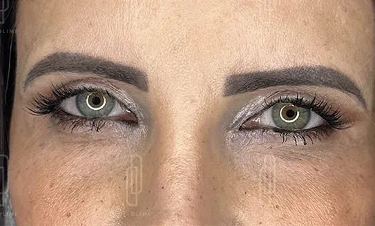 blépharoplastie avant intervention