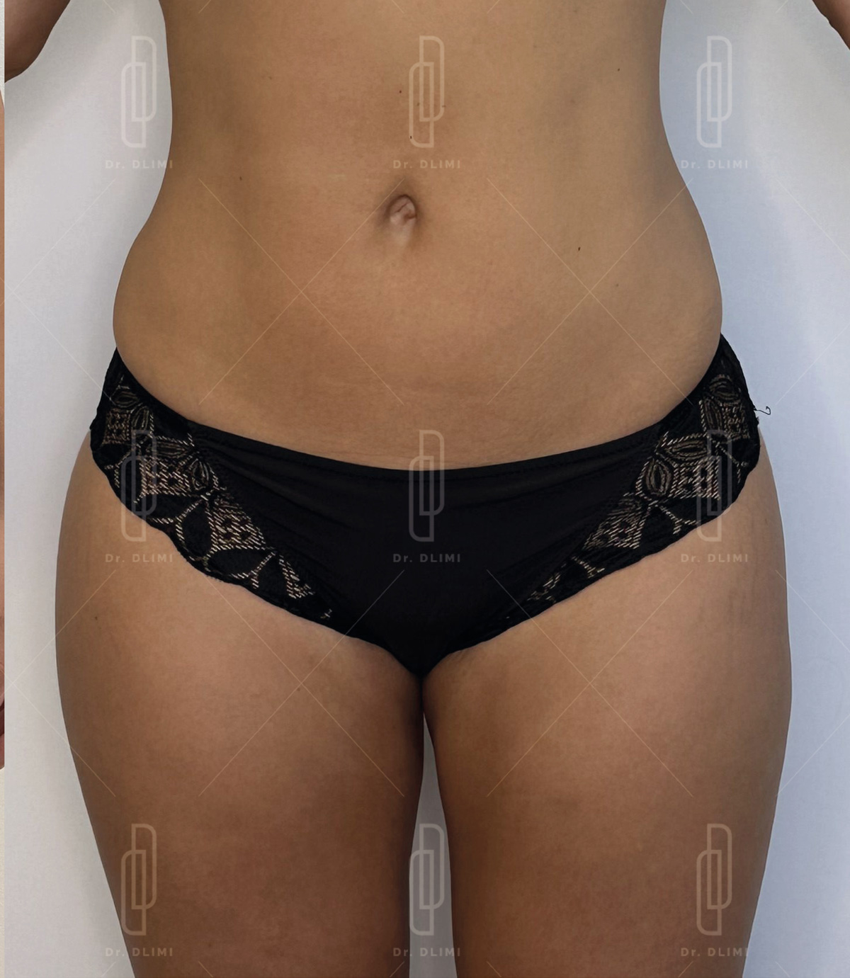 Après Liposuccion