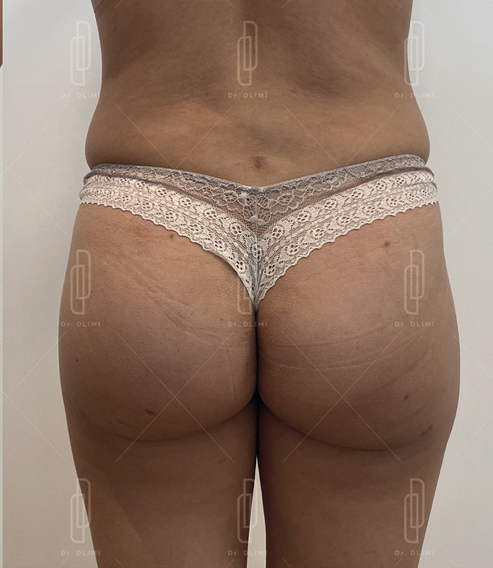 Après Prothèses de fesses