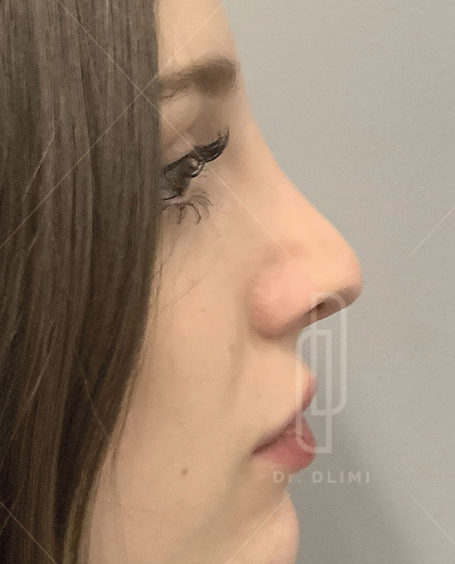 Après rhinoplastie