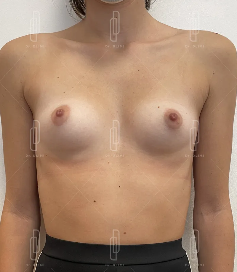 avant intervention augmentation mammaire composite