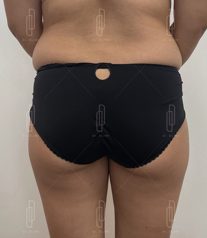 Avant Prothèses de fesses