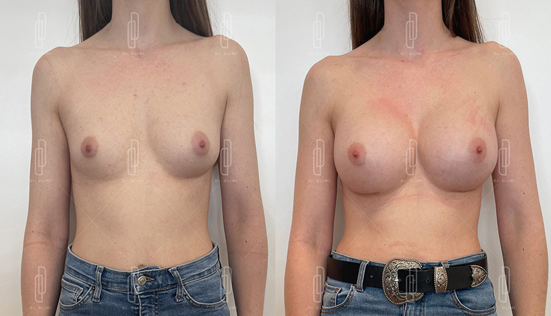 Augmentation mammaire par prothèses - Patiente 2 bonnet D