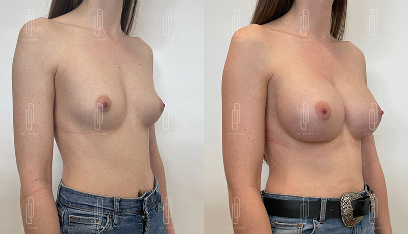 Augmentation mammaire par prothèses - Patiente 2 bonnet D