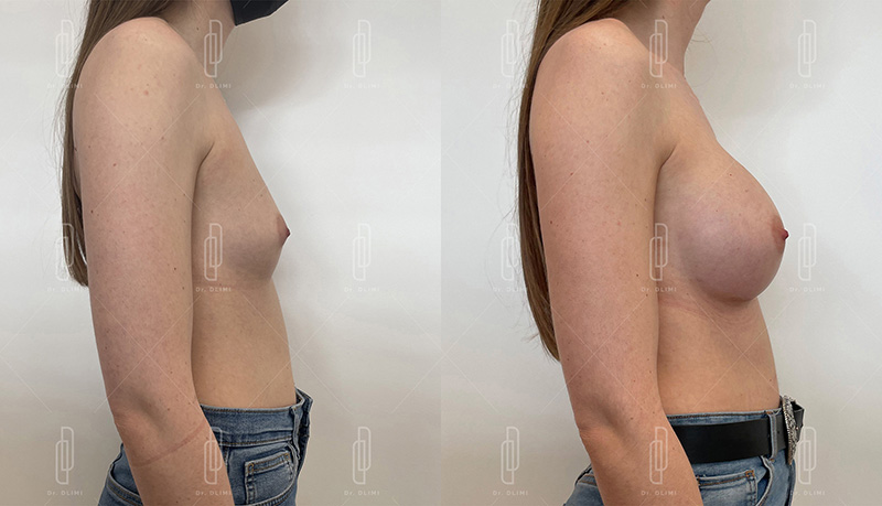 Augmentation mammaire par prothèses - Patiente 2 bonnet D