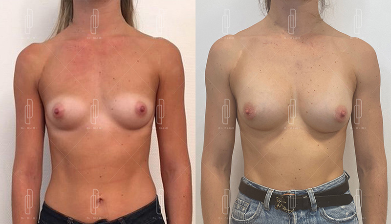 Augmentation mammaire par prothèses - Patiente 1