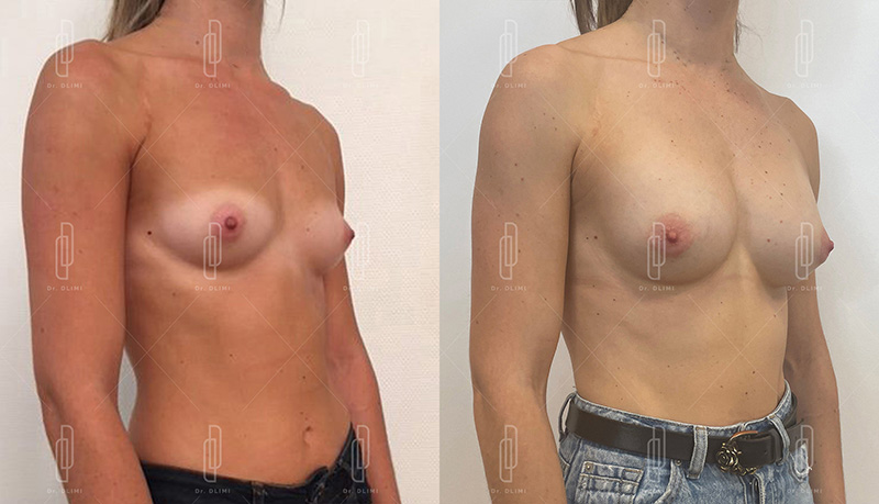 Augmentation mammaire par prothèses - Patiente 1