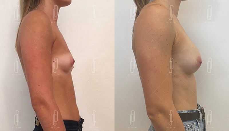 Augmentation mammaire par prothèses - Patiente 1