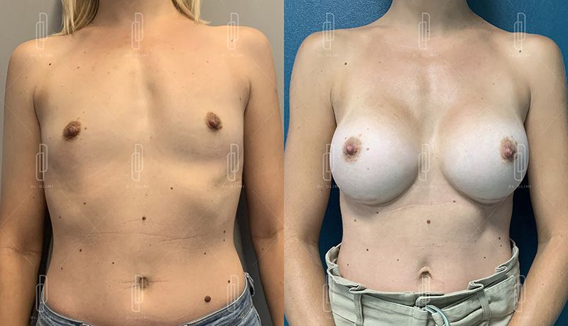 Augmentation mammaire par prothèses - Patiente 3