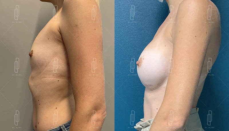 Augmentation mammaire par prothèses - Patiente 3