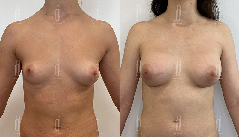 Augmentation mammaire par prothèses - Patiente 4