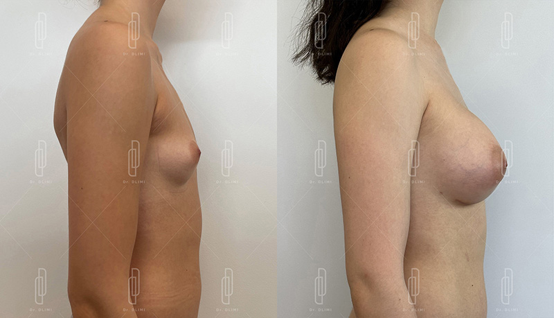Augmentation mammaire par prothèses - Patiente 4