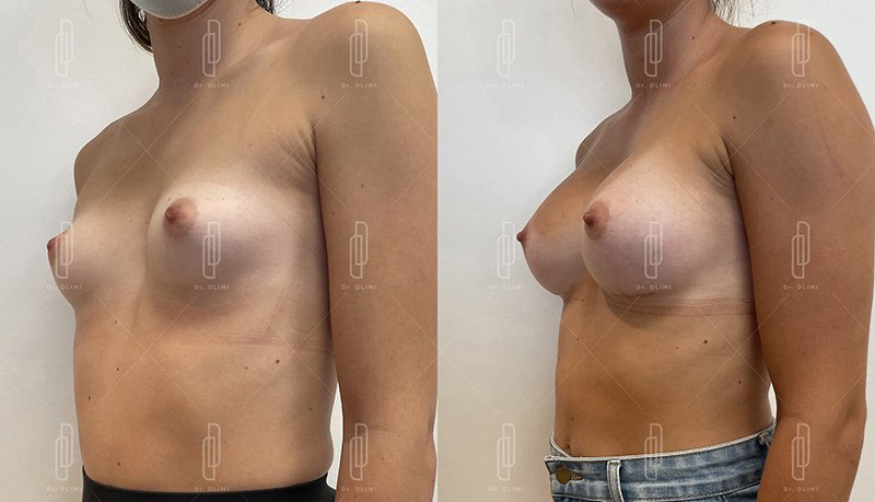 Augmentation mammaire par prothèses - Patiente 5