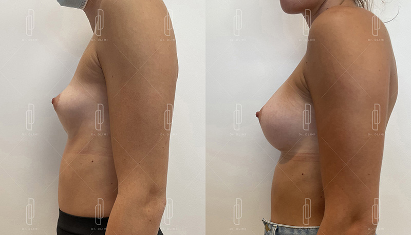 Augmentation mammaire par prothèses - Patiente 5