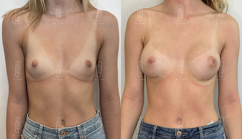 Augmentation mammaire par prothèses - Patiente 6