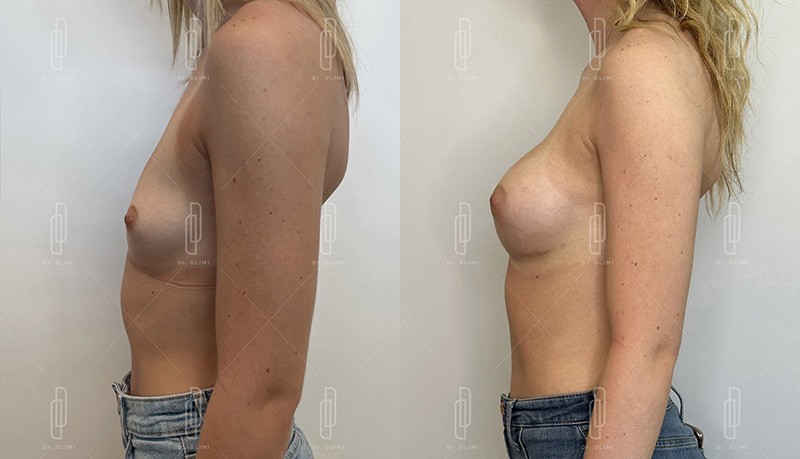 Augmentation mammaire par prothèses - Patiente 6