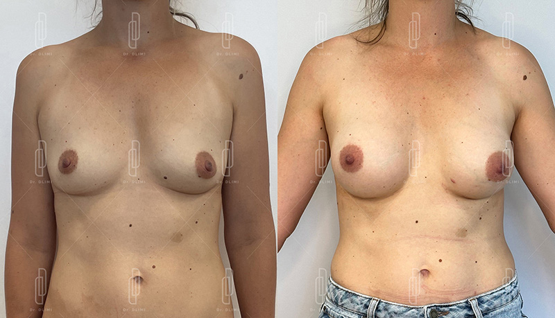Augmentation mammaire par prothèses - Patiente 8