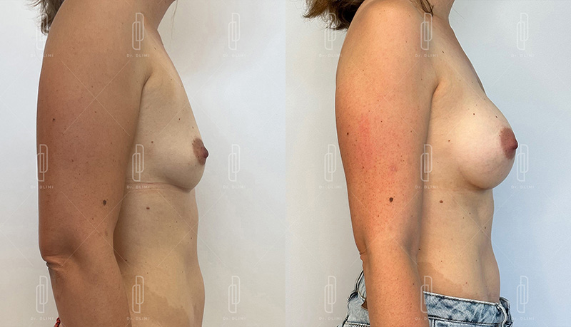 Augmentation mammaire par prothèses - Patiente 8