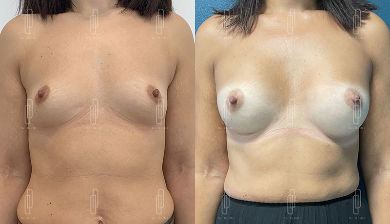 Augmentation mammaire par prothèses - Patiente 9