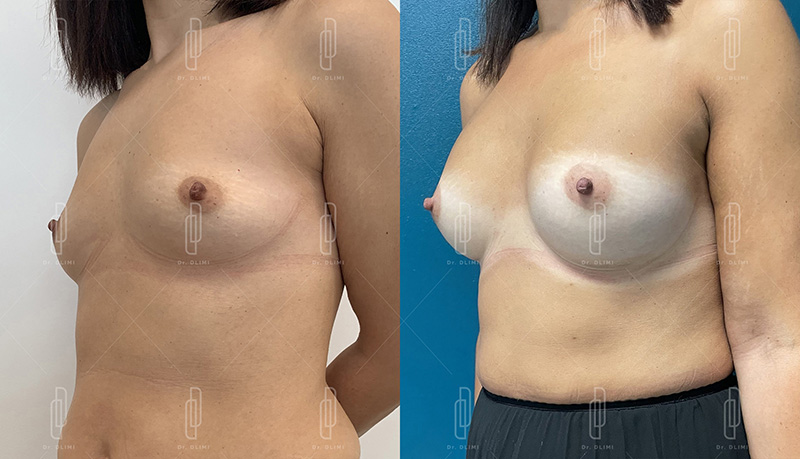 Augmentation mammaire par prothèses - Patiente 9