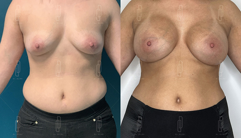 Augmentation mammaire par prothèses - Patiente 10
