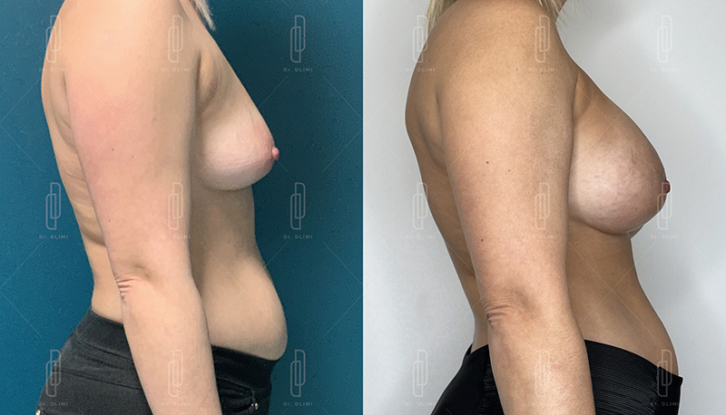 Augmentation mammaire par prothèses - Patiente 10