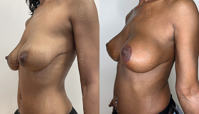 Lifting mammaire - Patiente 6
