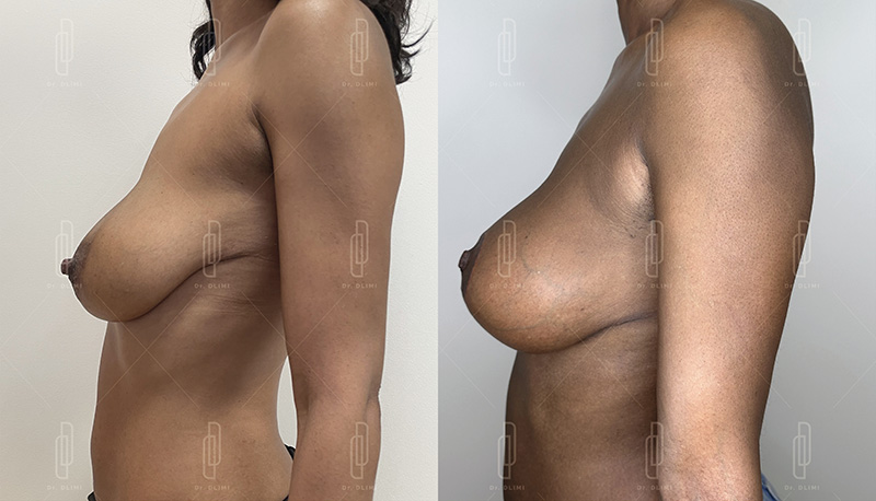 Lifting mammaire - Patiente 6
