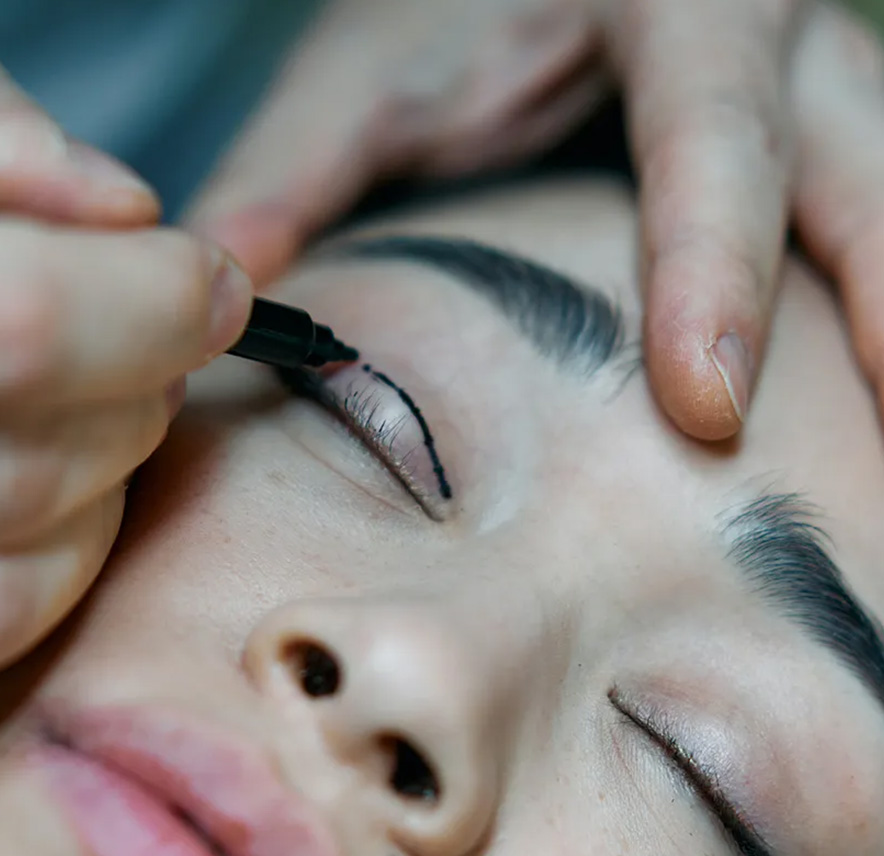 Blépharoplastie