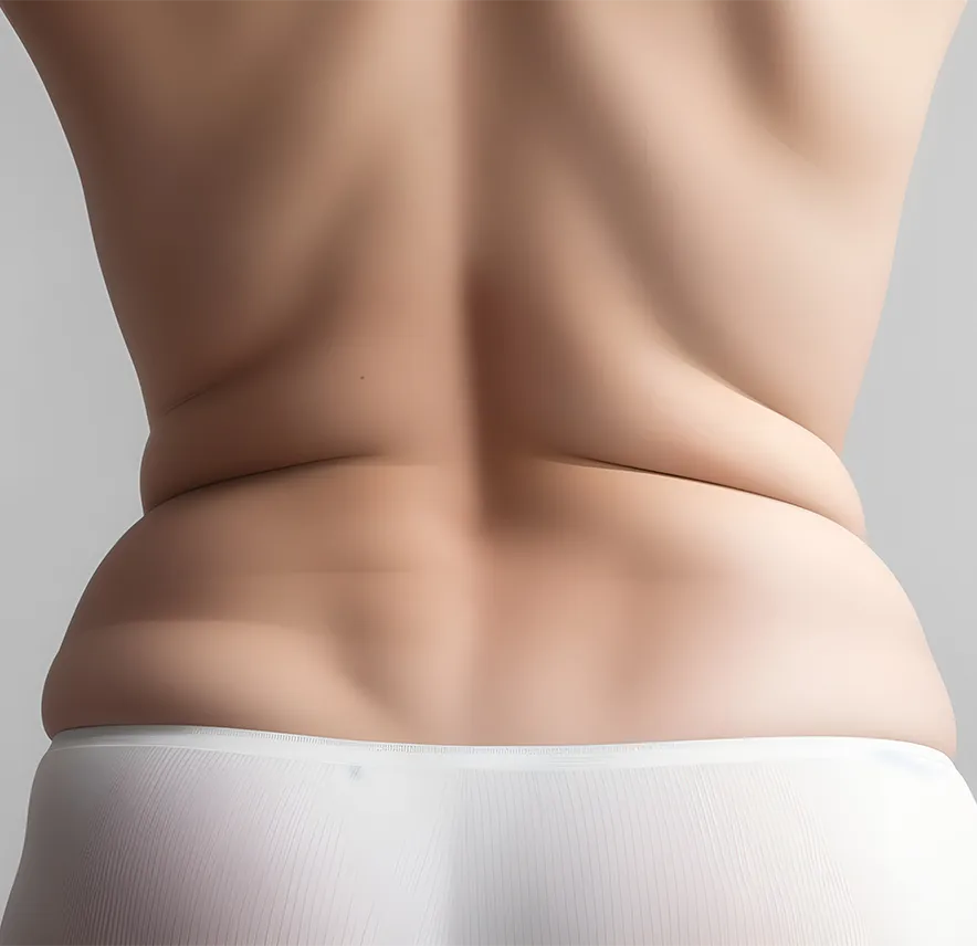 Liposuccion