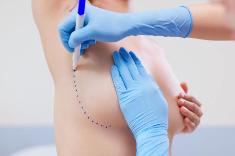 Chirurgie mammaire moderne | Dr Dlimi | Gen&egrave;ve