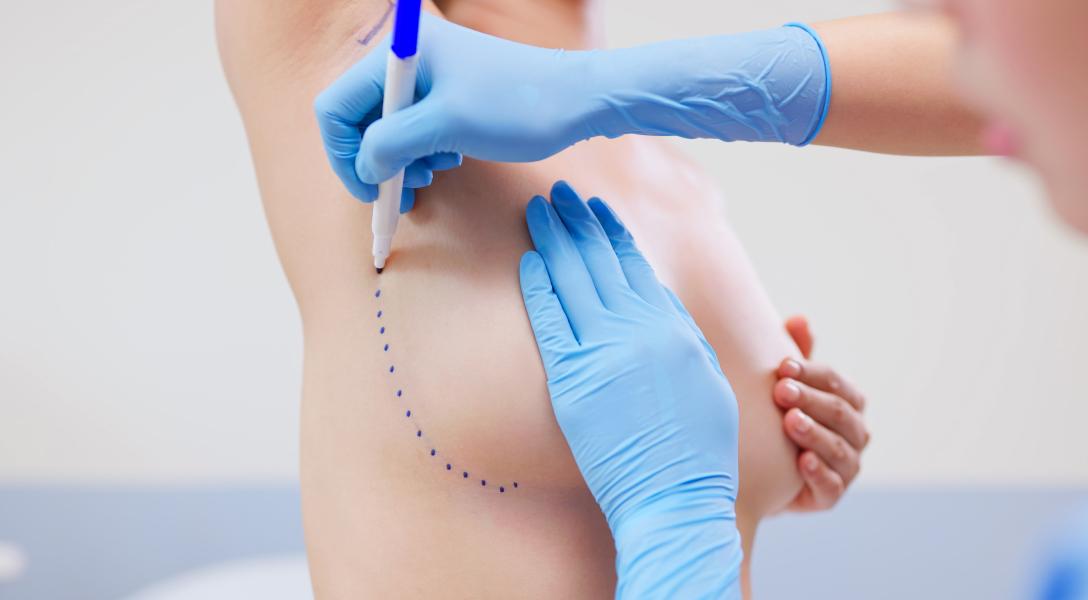 Chirurgie mammaire moderne | Dr Dlimi | Gen&egrave;ve